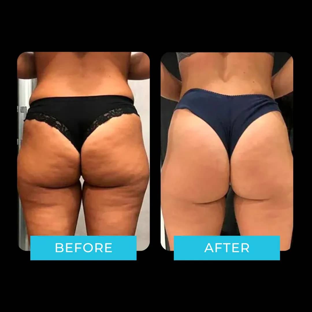 i-motion-antes-y-despues-resultados-1.jpg
